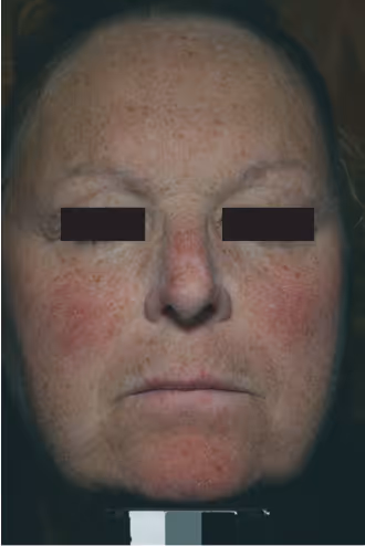 patient before Aerolase rosacea laser treatment
