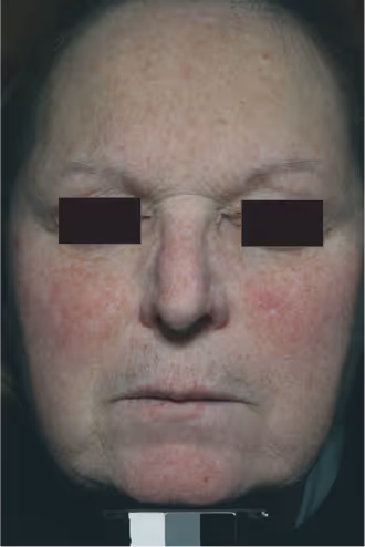patient after Aerolase rosacea laser treatment