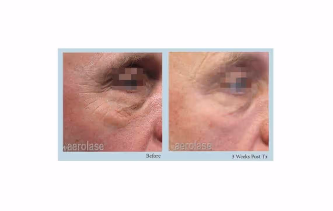 Skin resurfacing and renewal with the Aerolase Era