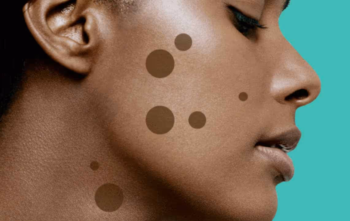 Trattare le macchie scure e cosa funziona meglio