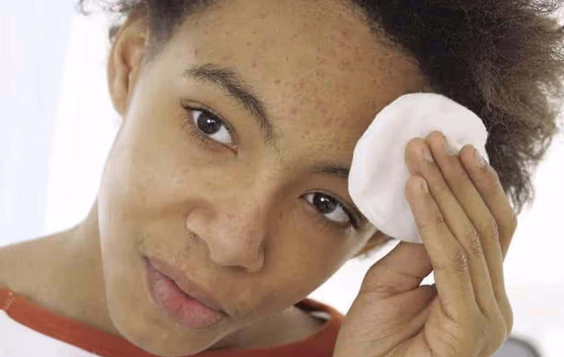 Acne affects people of all ages