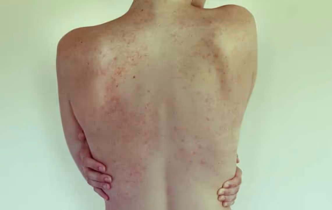 La enfermedad cutánea obstinada y autoinmune de la psoriasis