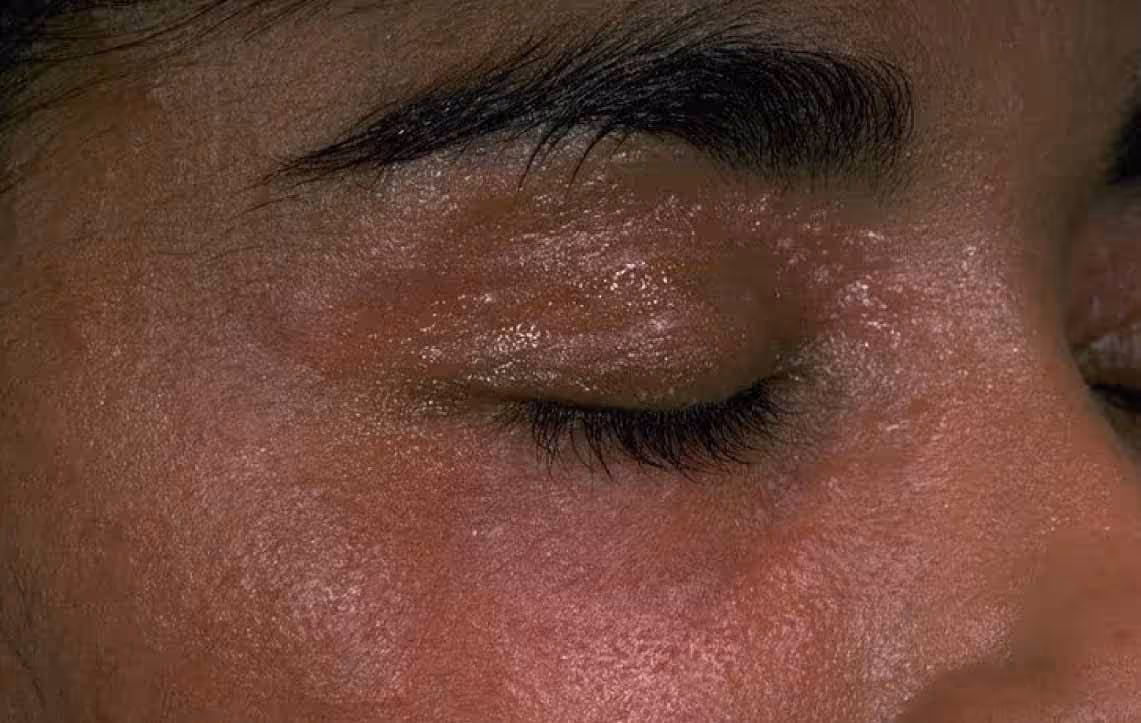 How to identify rosacea in skin of color patients