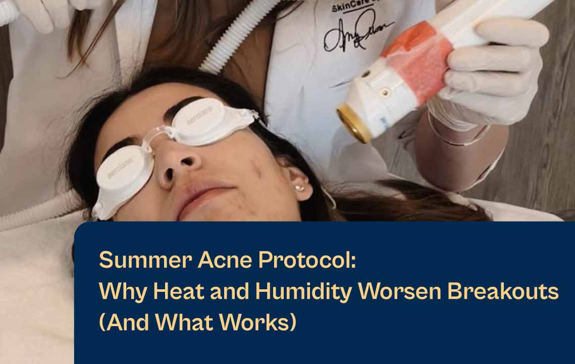 Aerolase Combat Summer Acne Blog