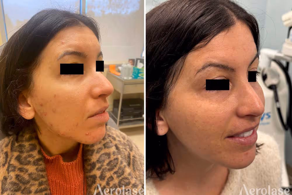 acne treatment before and after by dr. james newman