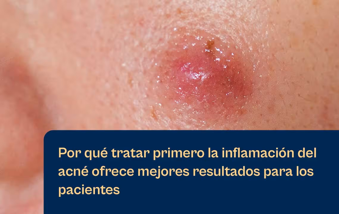 El acné comienza con la inflamación y estas son las razones por las que eso cambia todo para el tratamiento | Aerolase blog