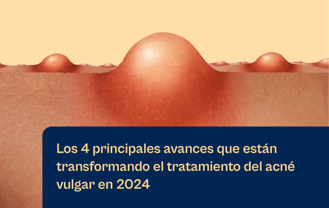 Los 4 principales avances de Aerolase que transformarán el tratamiento del acné vulgar en 2024