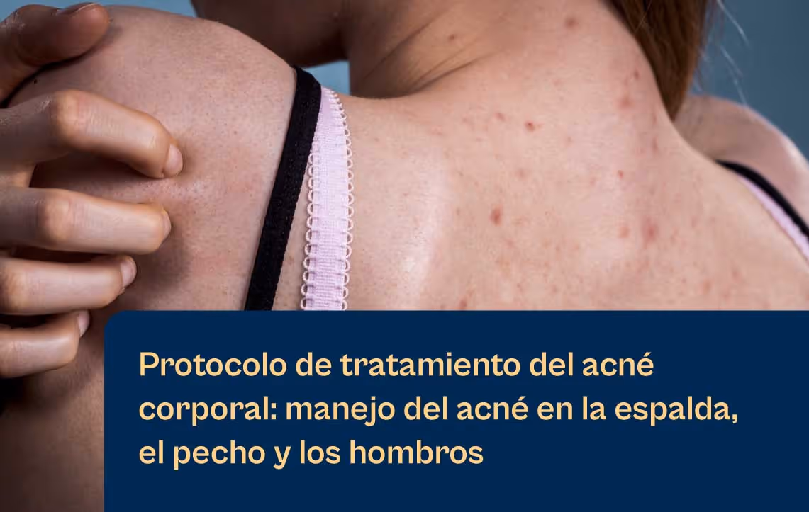 Protocolo de tratamiento del acné corporal con láseres Aerolase
