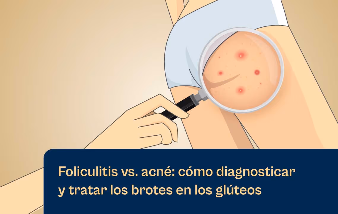 Cómo diagnosticar y tratar los brotes de glúteos con el láser Aerolase Neo
