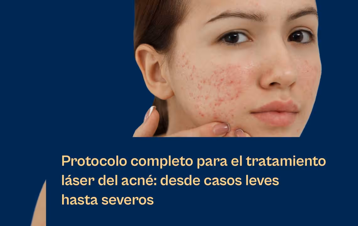 Terapia láser Aerolase Neo Elite para todas las formas de acné