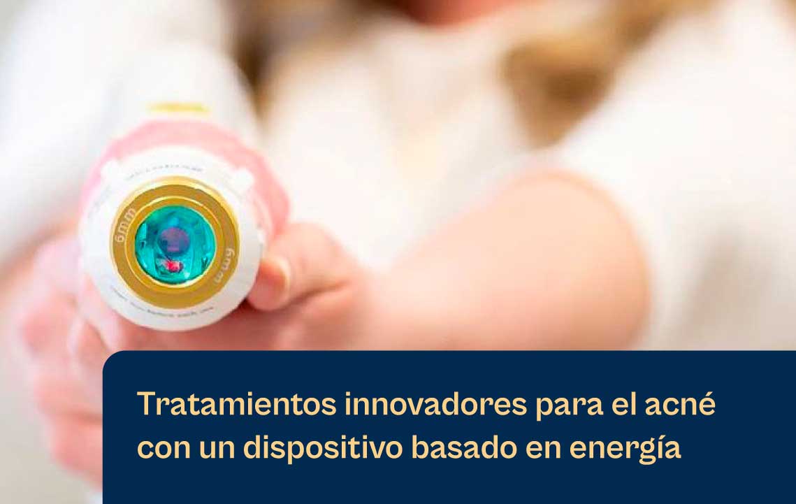 Tratamientos innovadores para el acné de Aerolase con un dispositivo a base de energía
