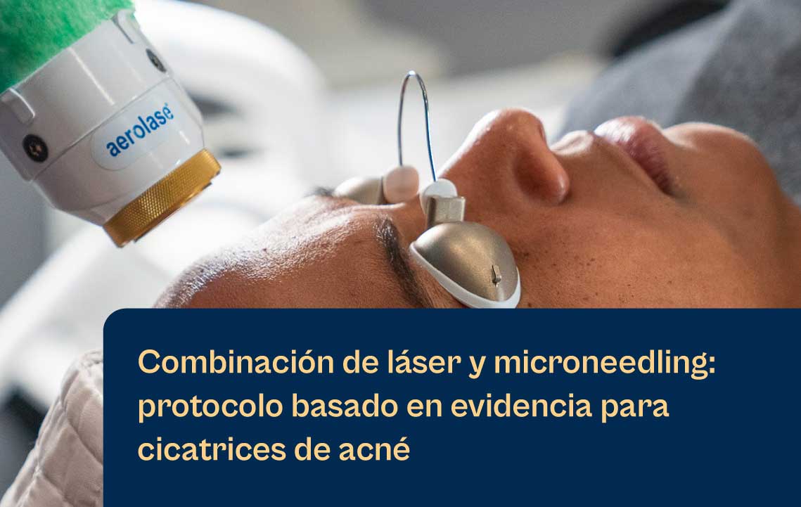 Combinando láser de Aerolase con microagujas: Protocolo basado en evidencia para cicatrices de acné blog