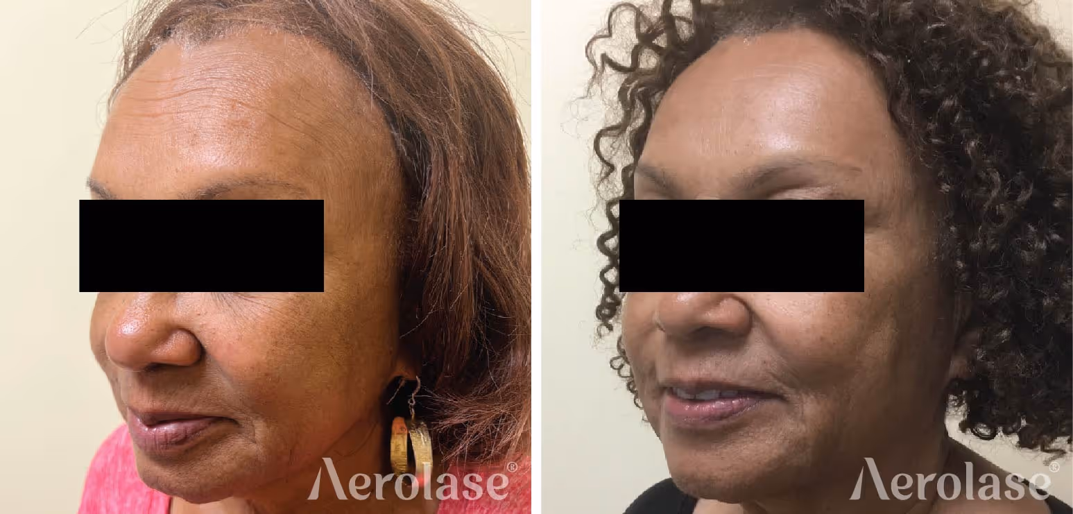 Aerolase Neo + Era results by Dr. Chesahna Kindred.