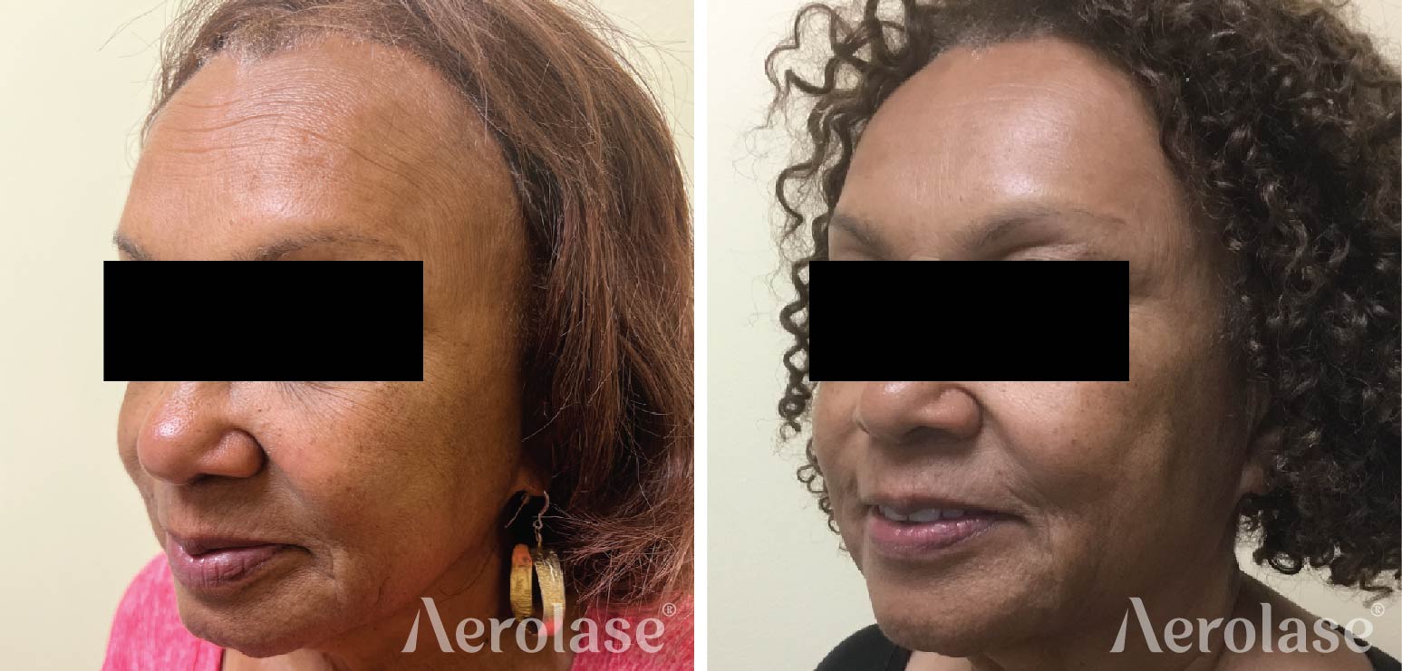 Aerolase Neo + Era results by Dr. Chesahna Kindred.