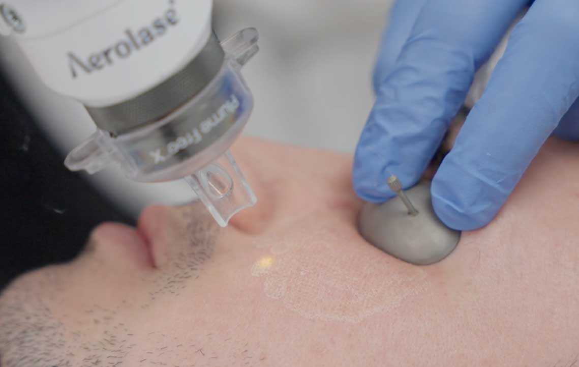 Wie Hybrid-fraktionelles Resurfacing Aknenarben behandelt: Ein klinischer Einblick mit Dr. James Gordon