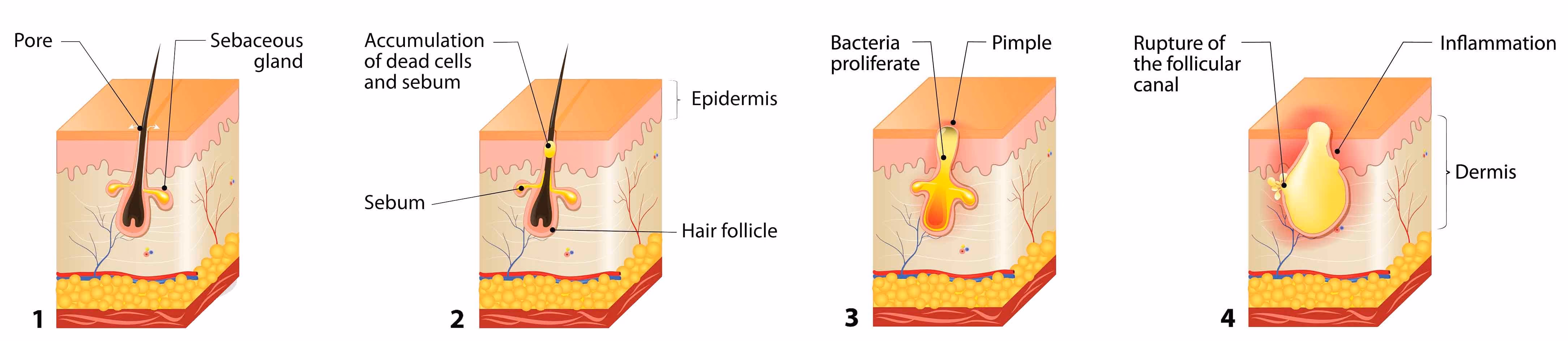 graphic portraying the formation of acne