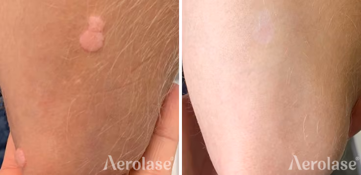 warts courtesy of elevate wellness and aesthetics