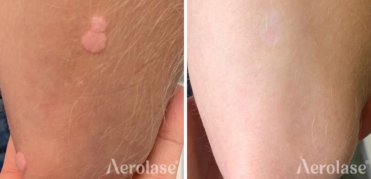 warts courtesy of elevate wellness and aesthetics