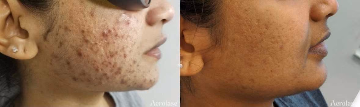 Acne treatment after 3 sessions with Neo. Photos courtesy of Nina Harry, FNP-BC.