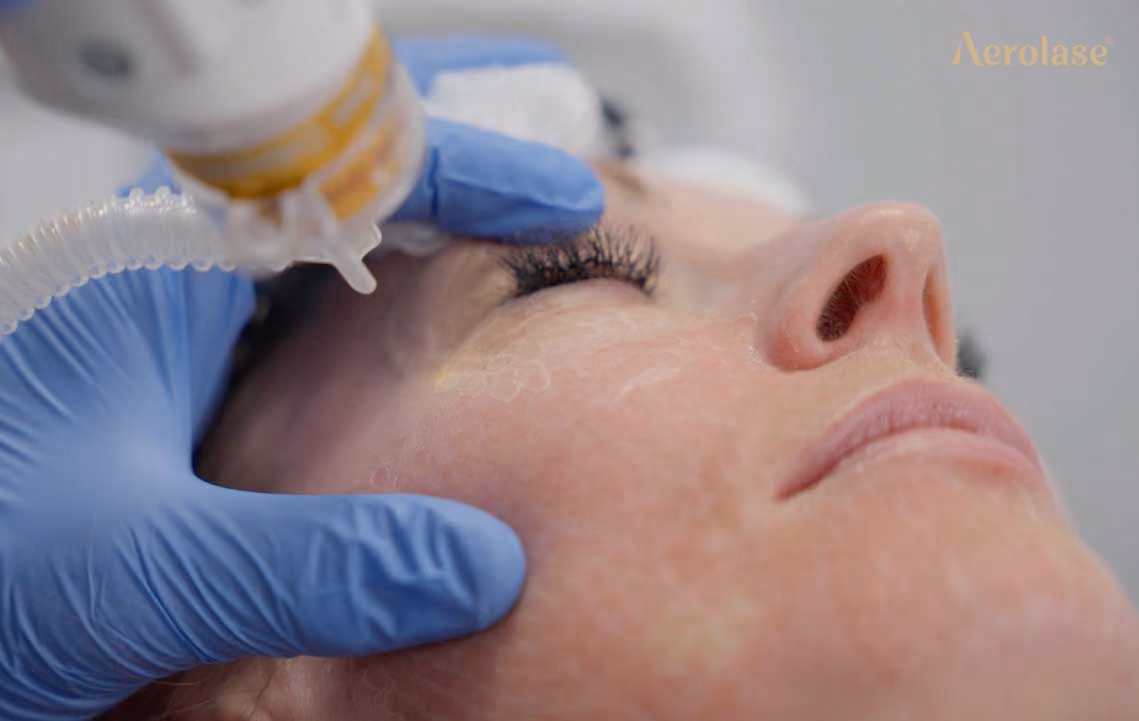 Era Elite 6mm lens periorbital perioral resurfacing blog