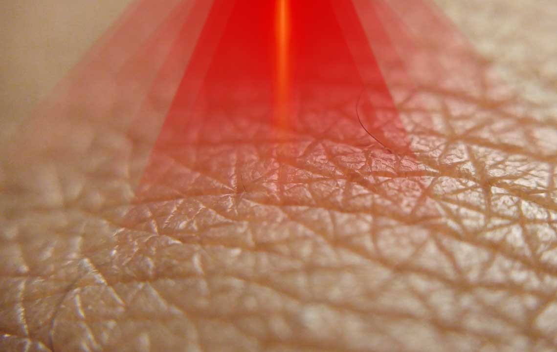 Imagen de Cómo elegir un láser dermatológico en 2026