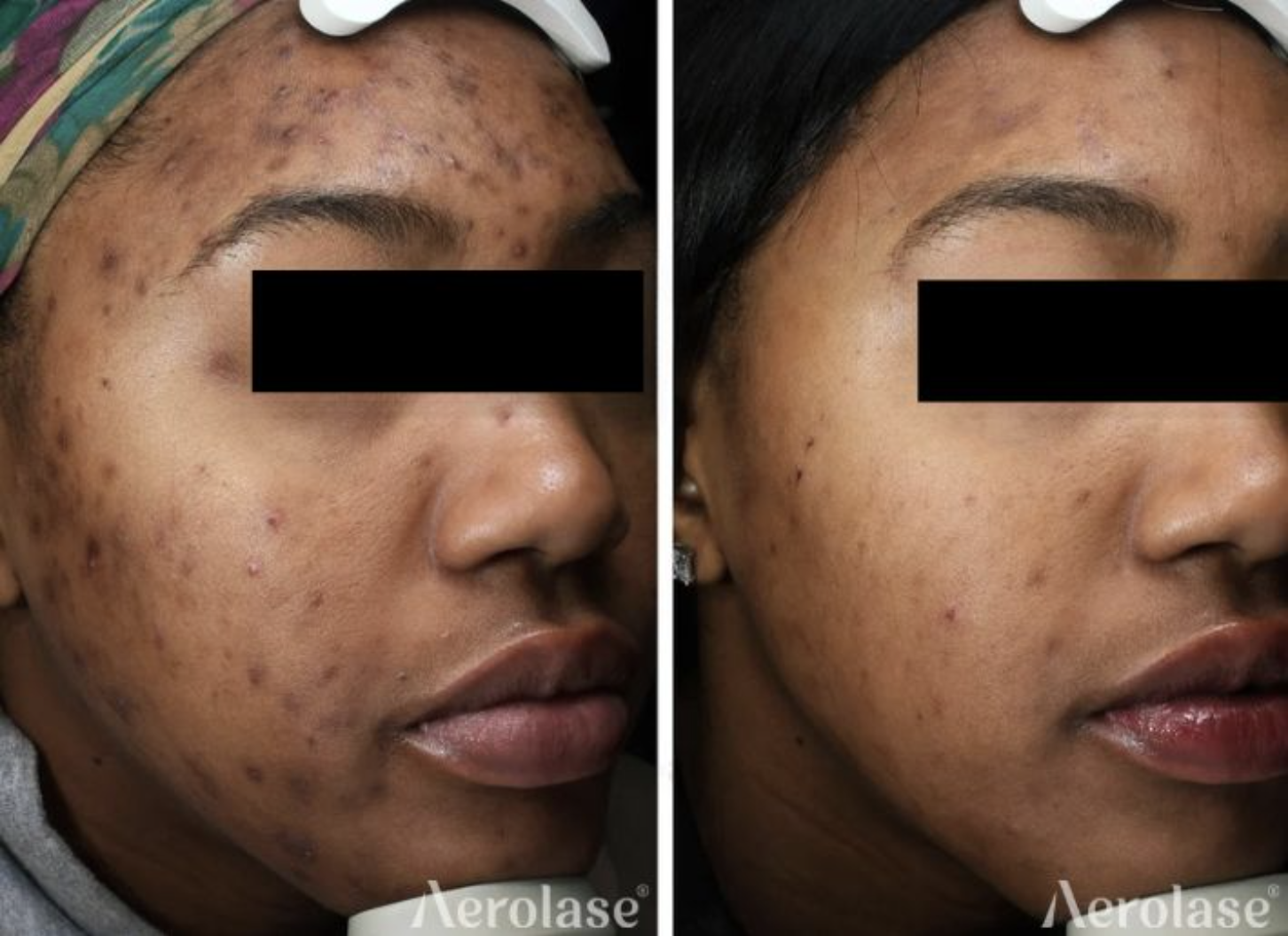 Acne patient after 5 treatments with the Aerolase Neo.