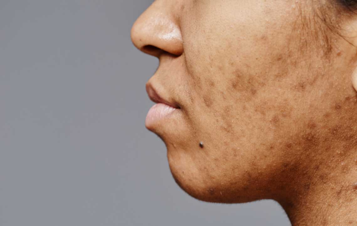PIH Risk in Laser Treatment for Dark Skin blog cover