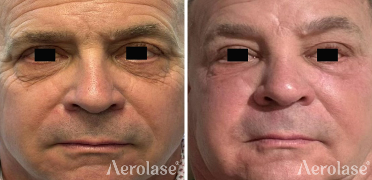 Era Hybrid Fractional Fitzpatrick 2 Patient, After 2 Treatments for Under Eye Rejuvenation