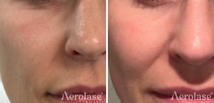 Era Hybrid Fractional Fitzpatrick 2 Patient After 1 Treatment for Tone and Texture Rejuvenation