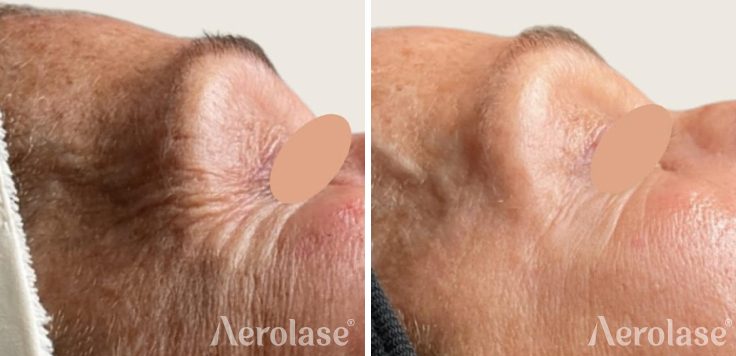 Era Hybrid Fractional Fitzpatrick 2 Patient After 1 Treatment for Wrinkles and Fine Lines