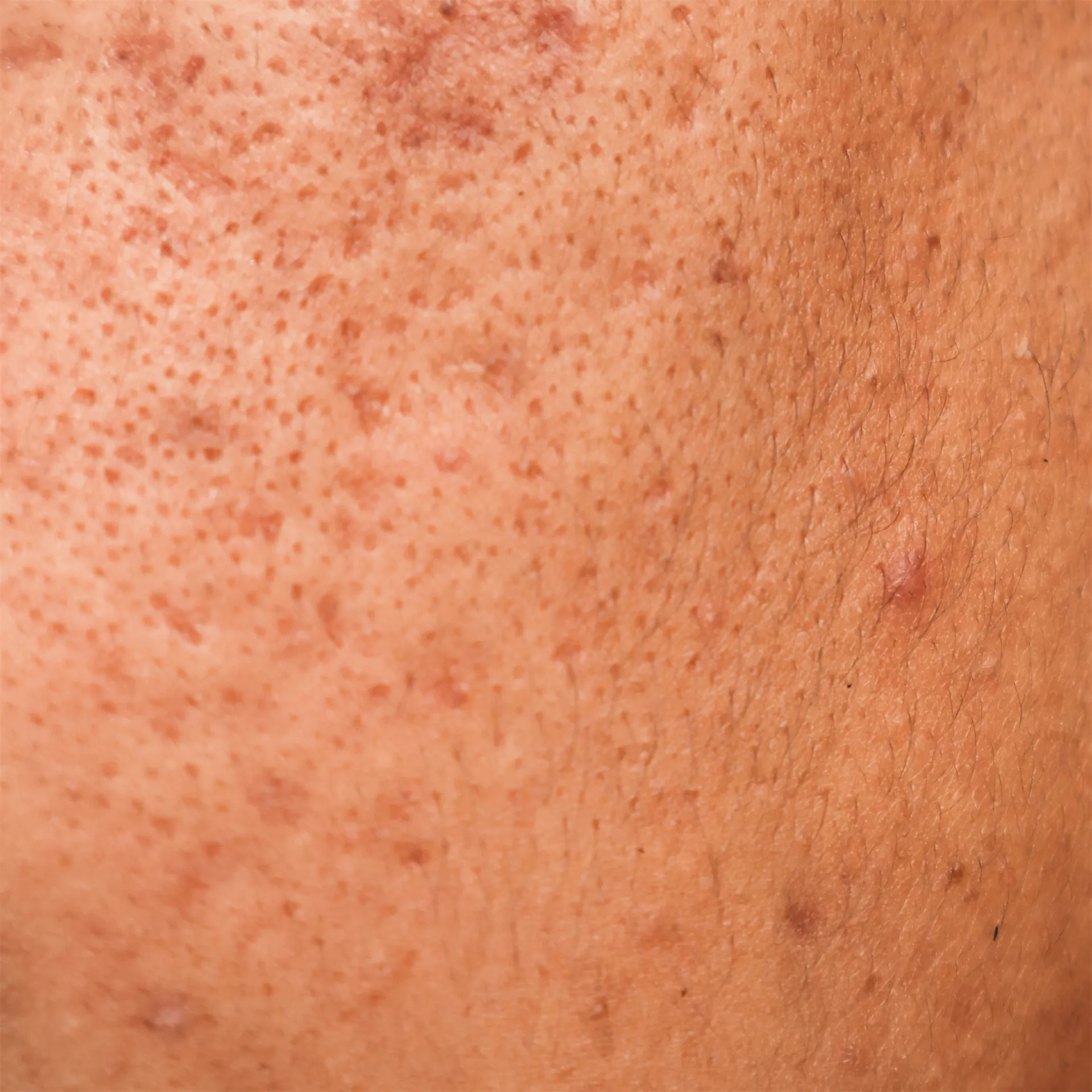 Close up of a man's cheek, showing pits and dimples from acne scarring