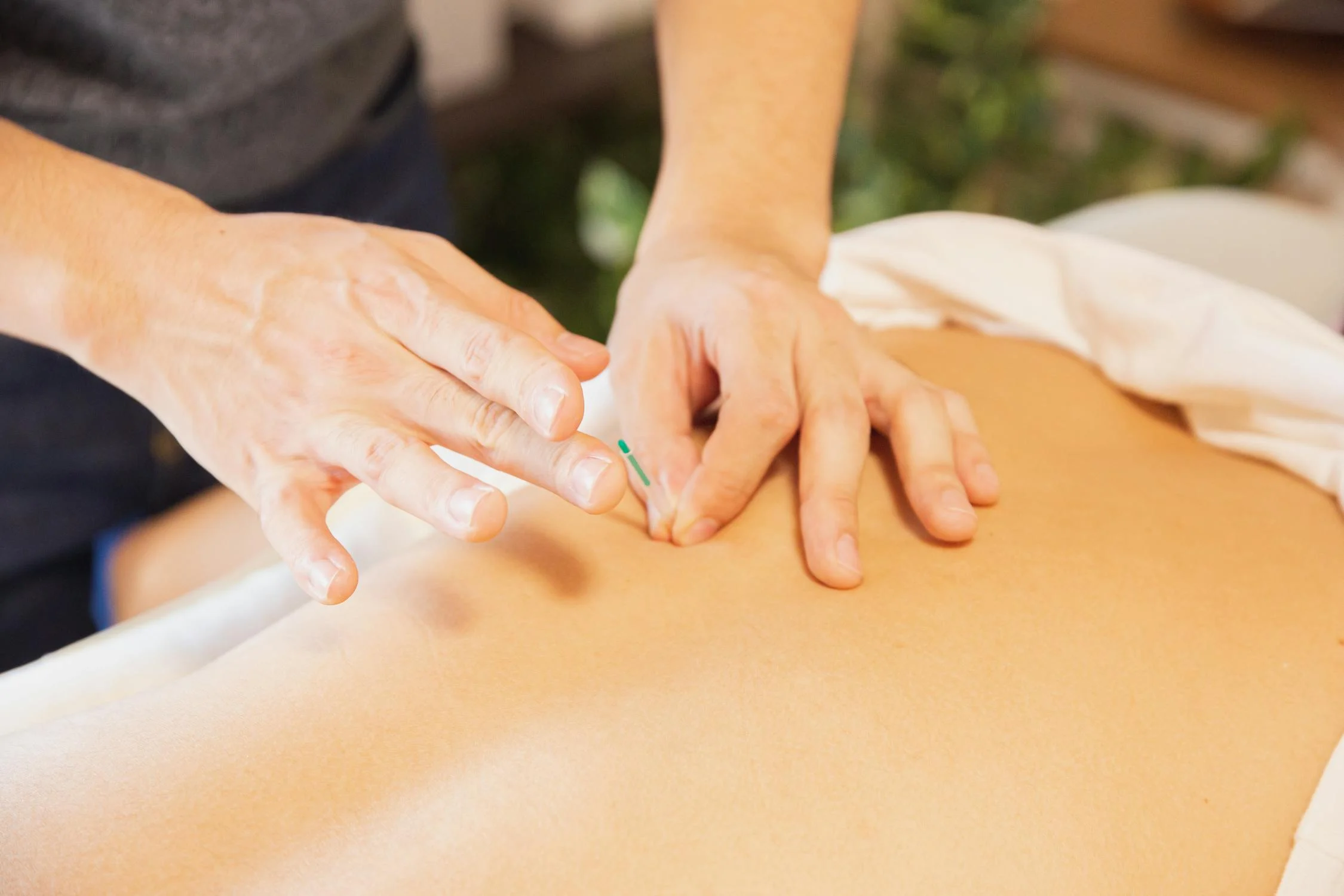 A woman receiving dry needling on her lower back.