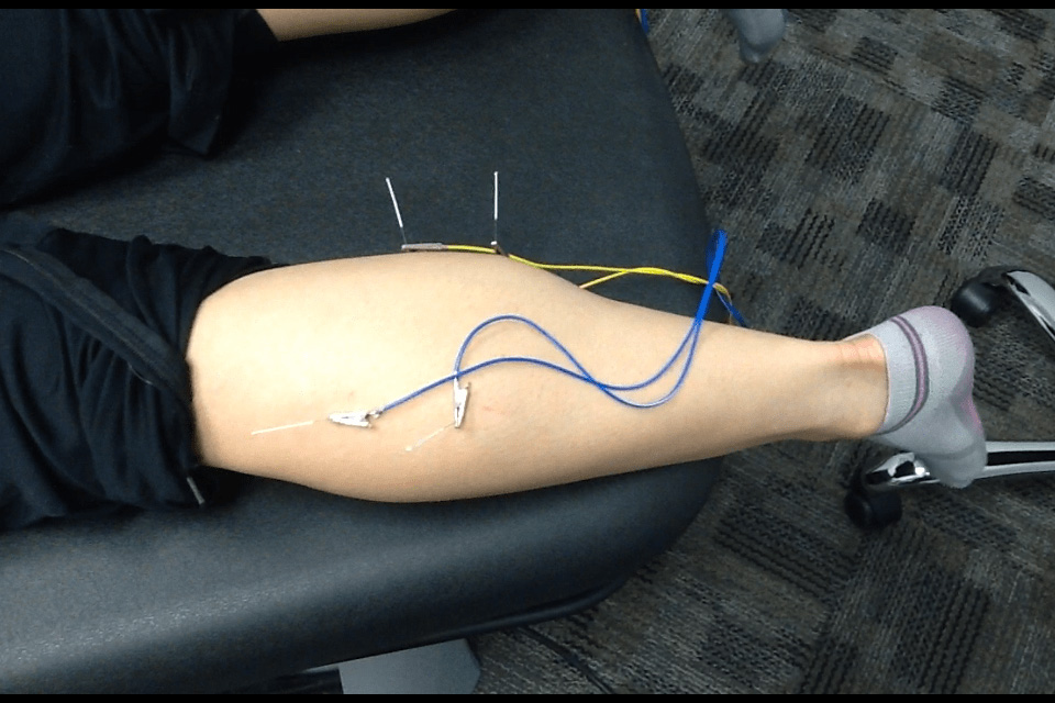 https://www.behmmjc.com/images/easyblog_articles/25/trigger-point-dry-needling-the-calf.jpg