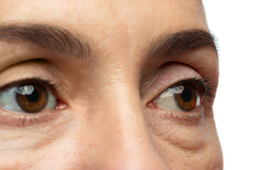 A close up shot of a woman's eye bags on a white background