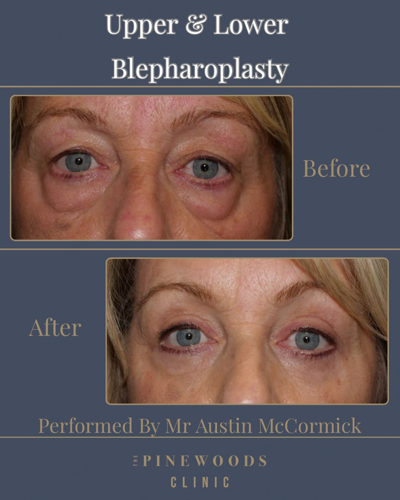 Upper and lower blepharoplasty before and after at The Pinewoods Clinic Liverpool