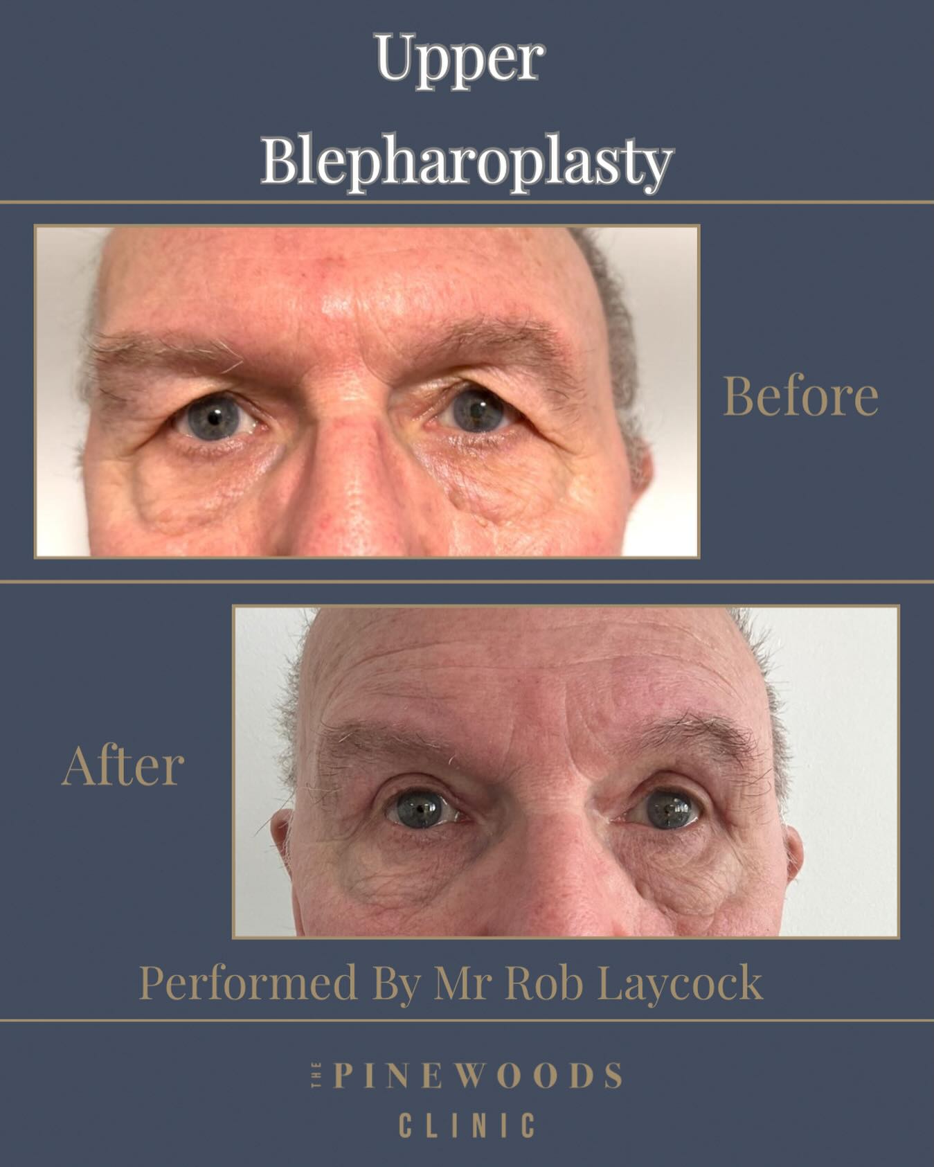 Upper blepharoplasty before and after at The Pinewoods Clinic Liverpool