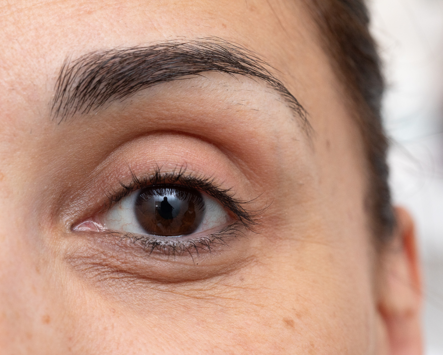 What Causes Under Eye Hollows?