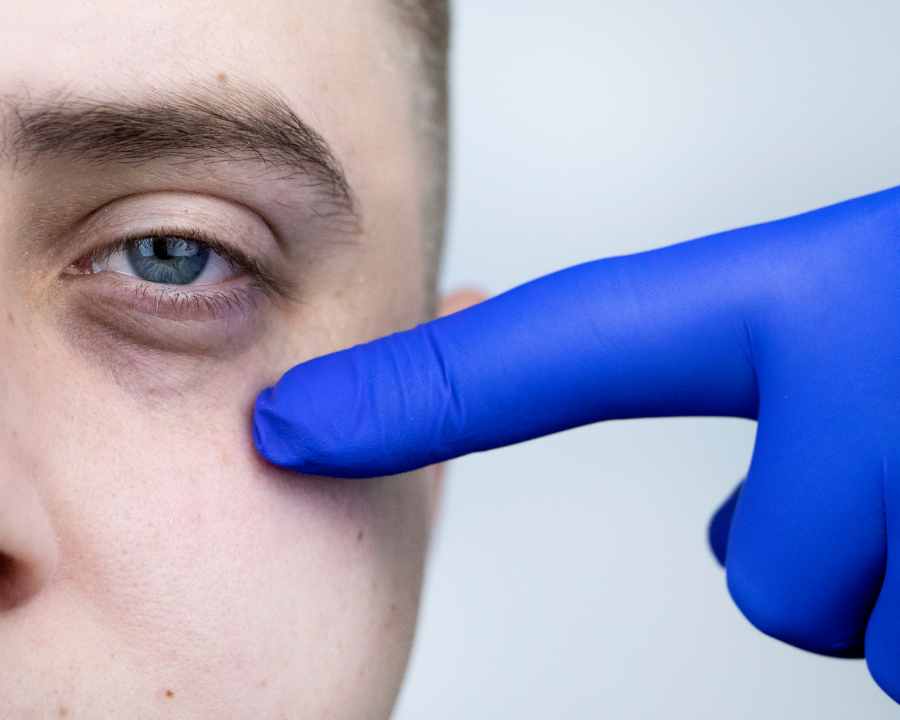 Sunken Eyes: What Causes Them And What Helps