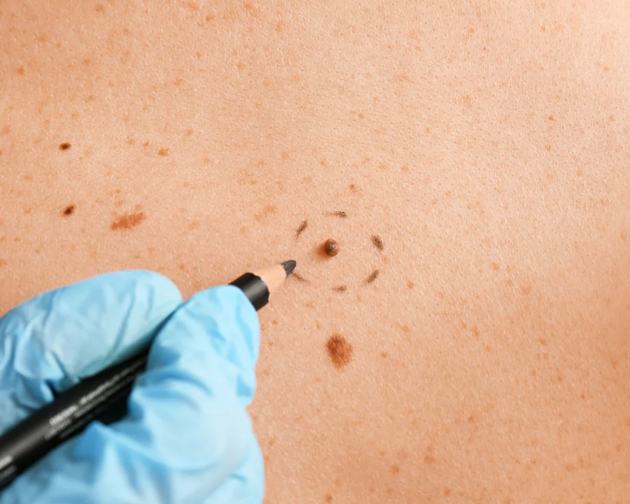 How Much Does Mole Removal Cost In The UK?