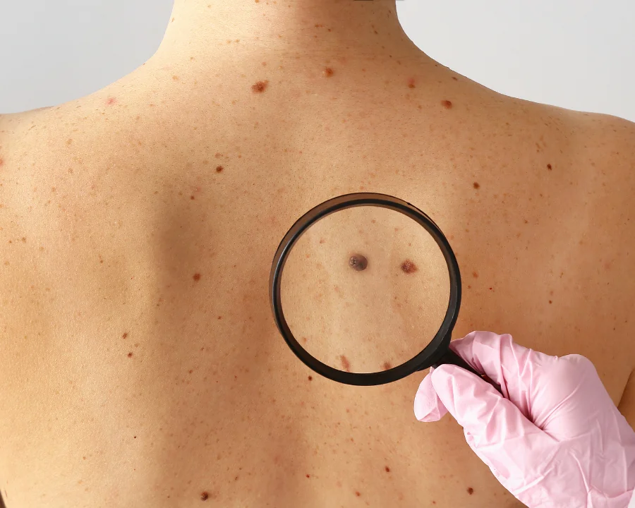 When Should You Get A Mole Checked?