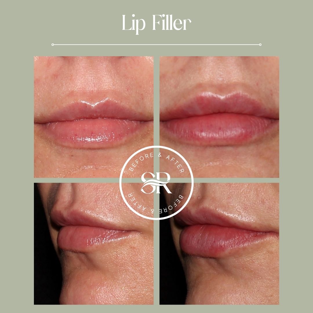Before and after dermal filler treatment at Severn River Medspa