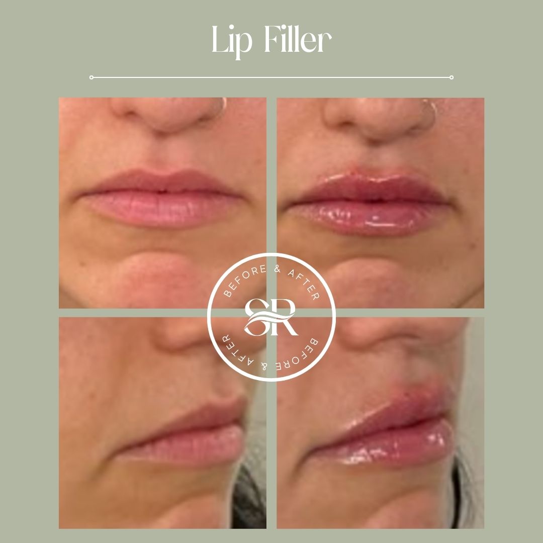 Before and after dermal filler treatment at Severn River Medspa