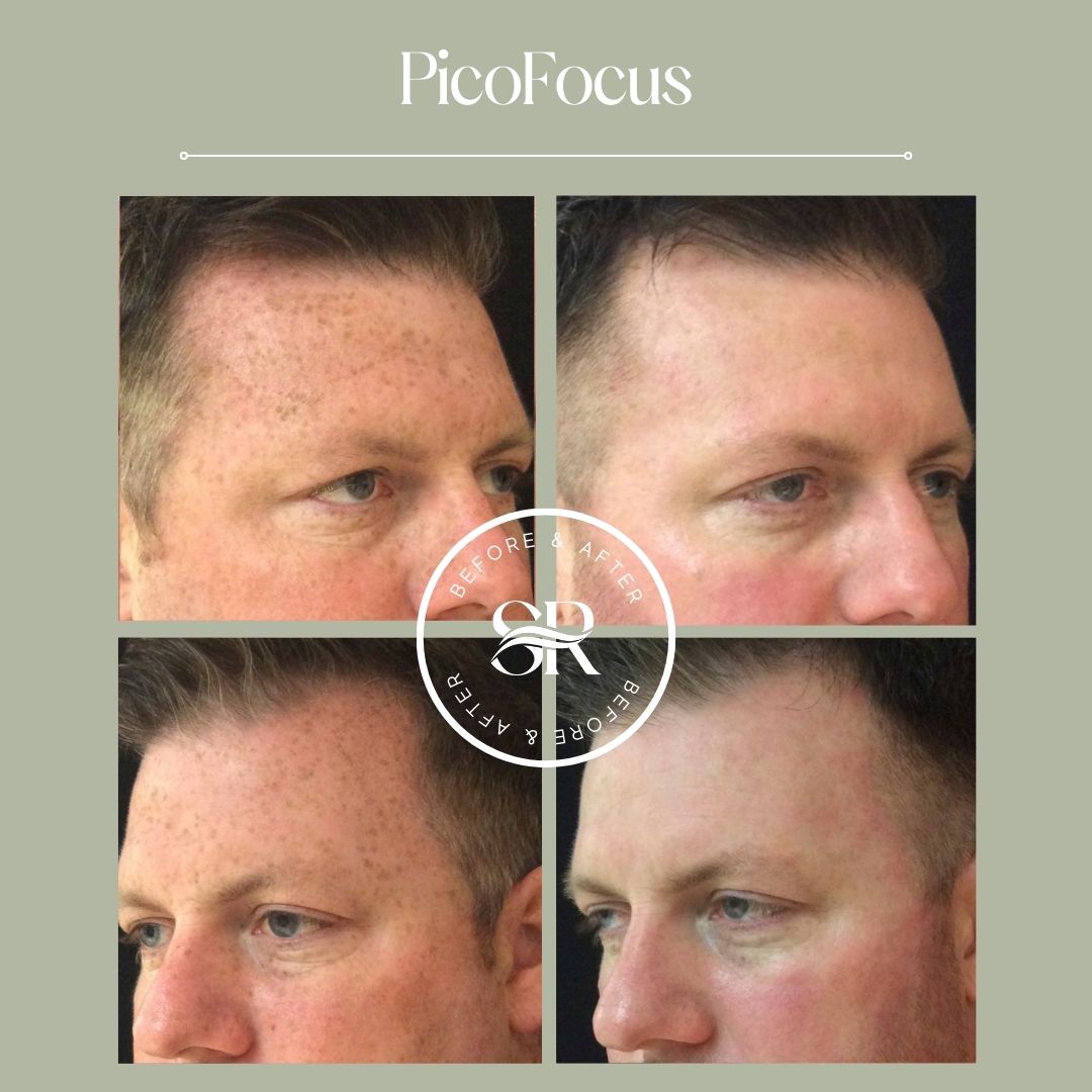 Before and after laser skin resurfacing at Severn River Medspa