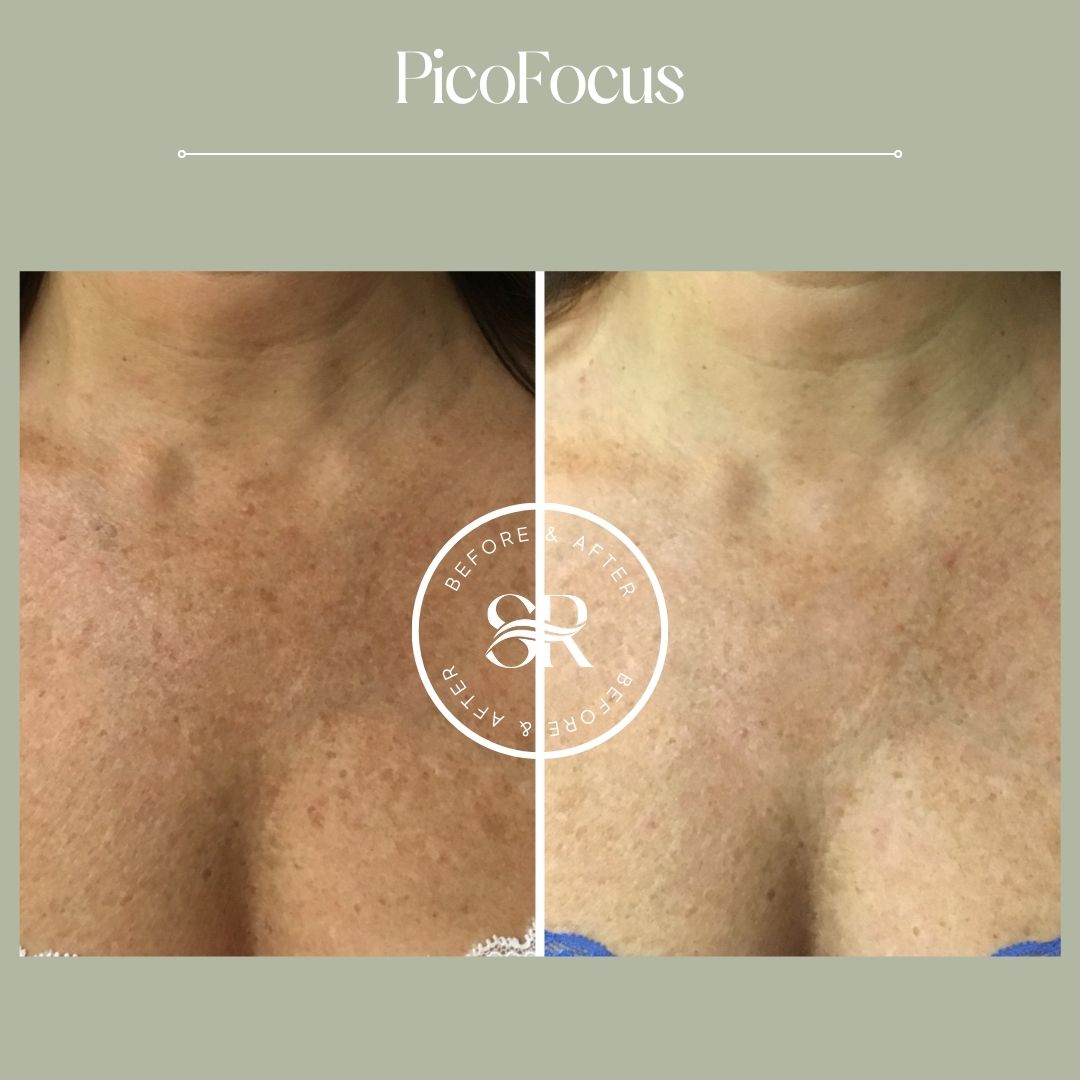Before and after laser skin resurfacing at Severn River Medspa