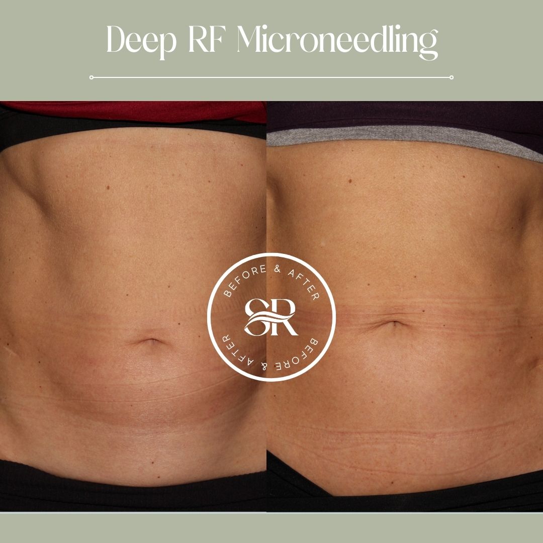 Before and after body contouring at Severn River Medspa
