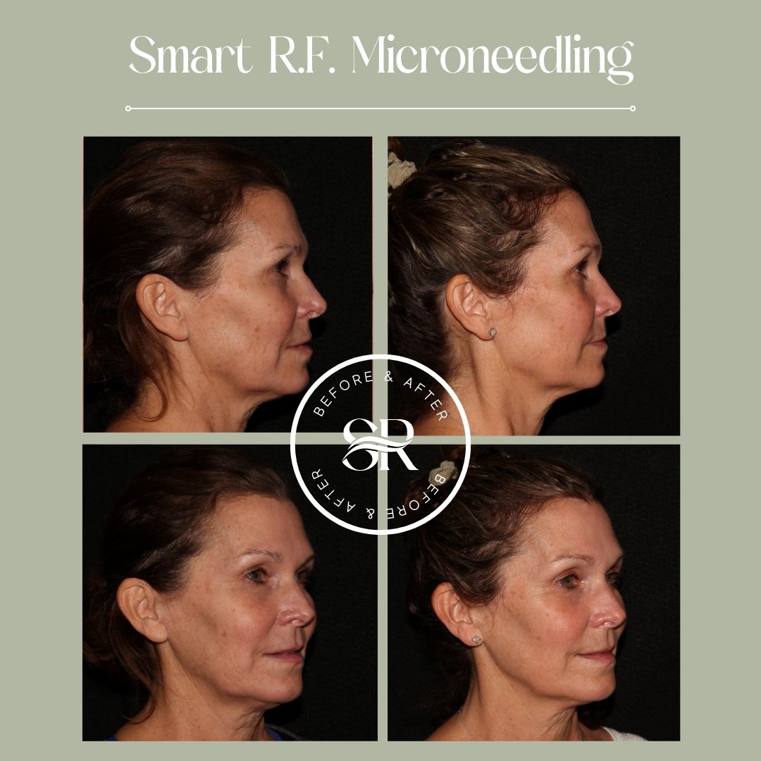 Before and after microneedling at Severn River Medspa