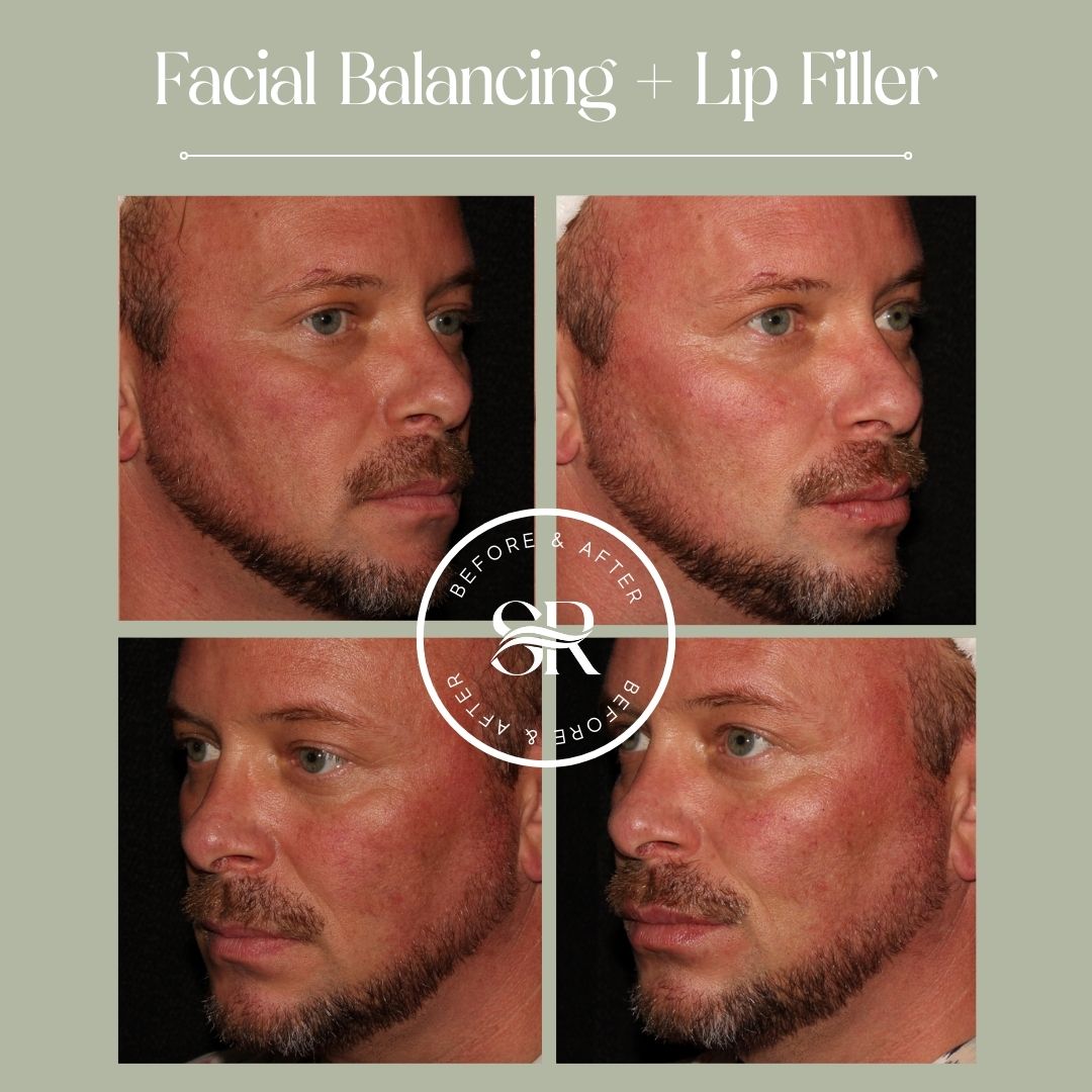 Before and after dermal filler treatment at Severn River Medspa
