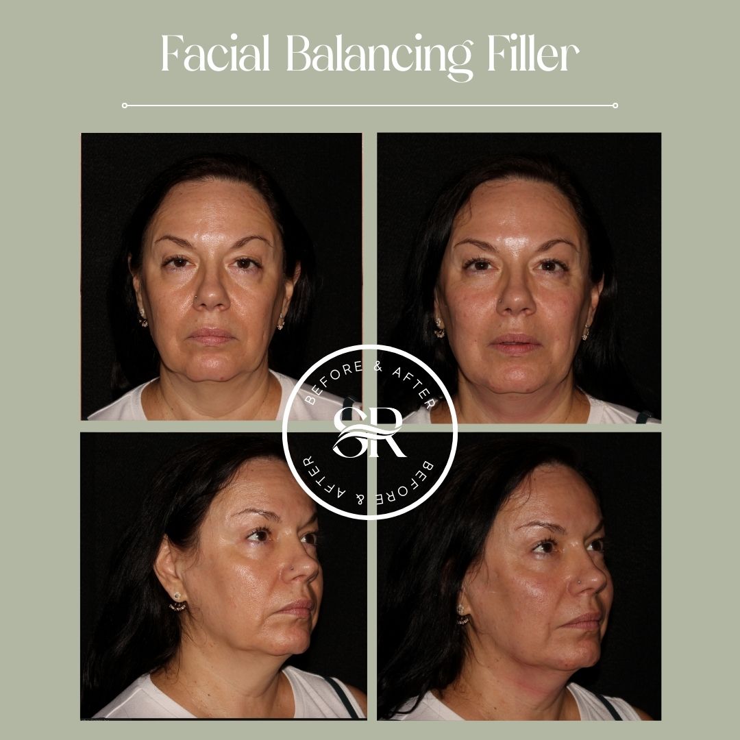 Before and after dermal filler treatment at Severn River Medspa