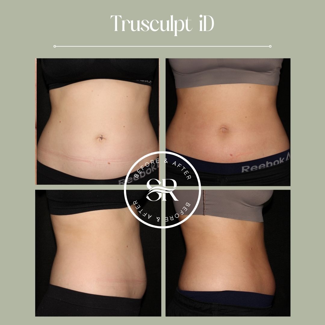 Before and after body contouring at Severn River Medspa
