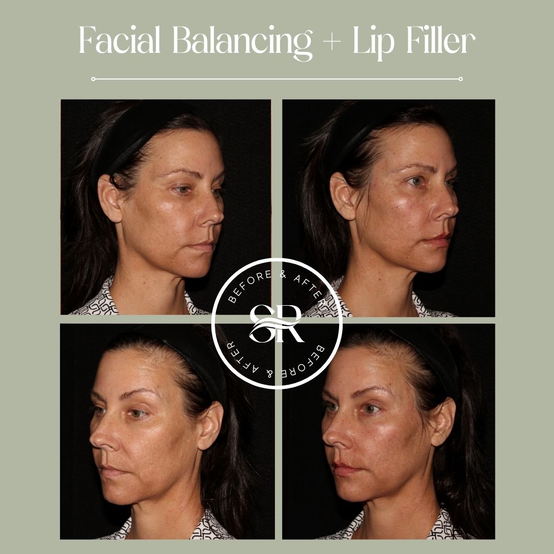 Before and after dermal filler treatment at Severn River Medspa